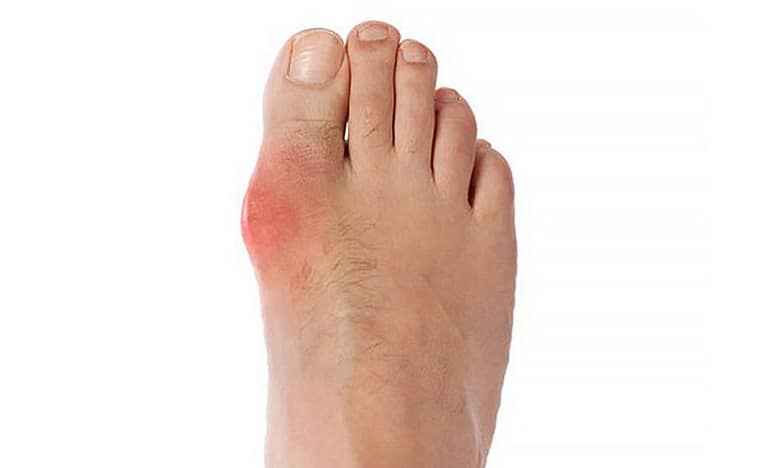 gout