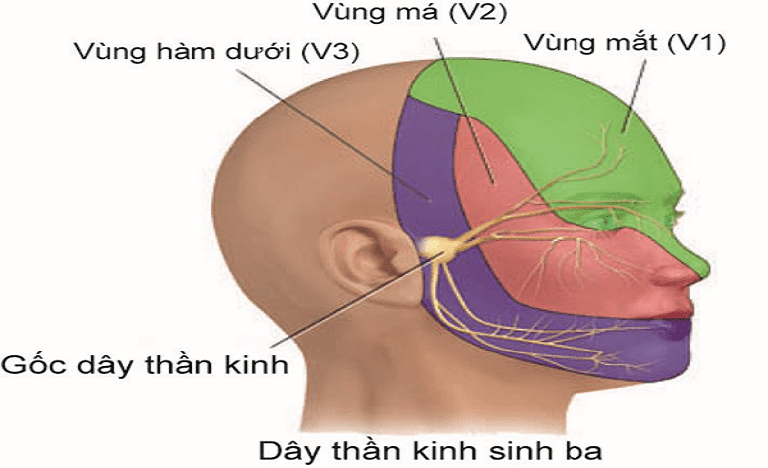 đau dây thần kinh sốV