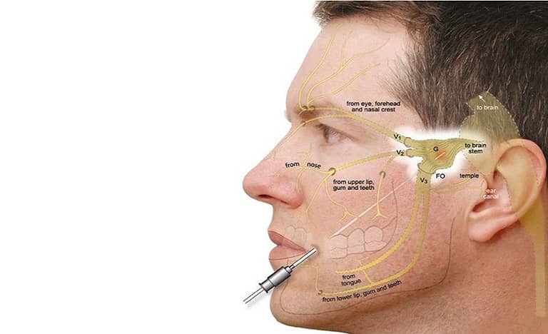 đau dây thần kinh số V