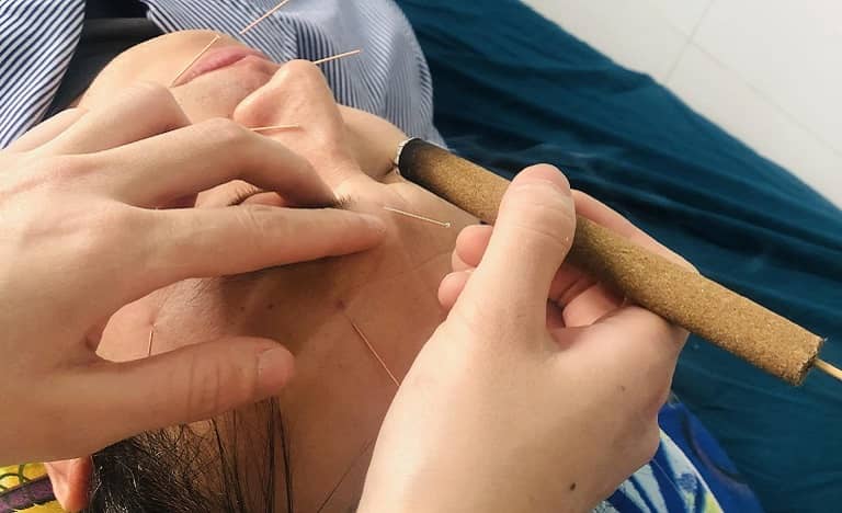 châm cứu trị liệt dây thần kinh số 7