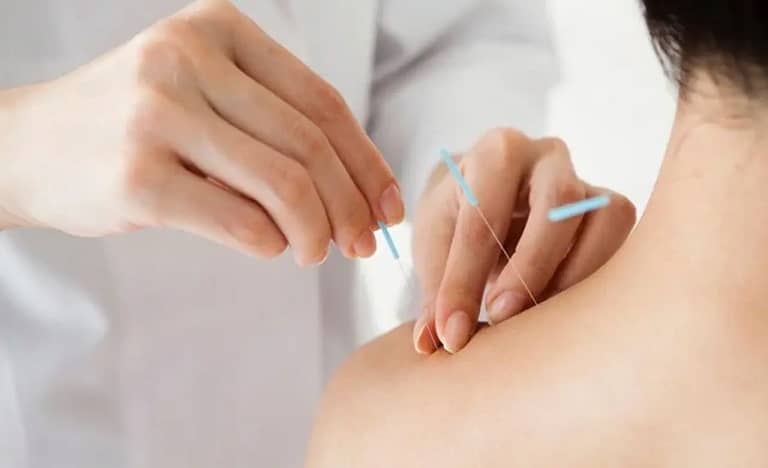 Châm cứu điều trị đau cổ vai gáy tại Quận 10